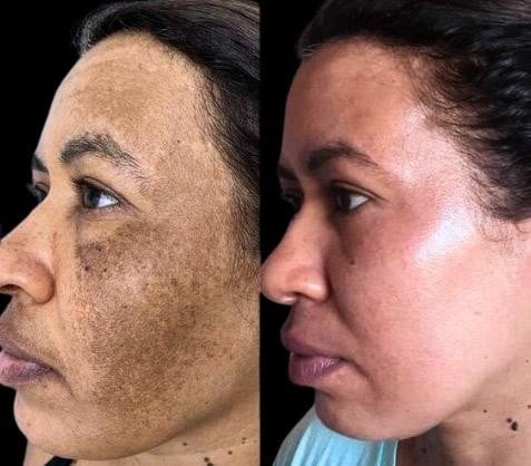 Resultado de tratamento 2