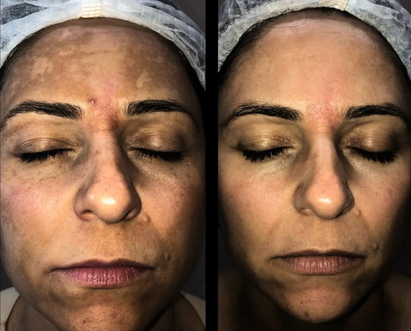 Resultado de tratamento 5